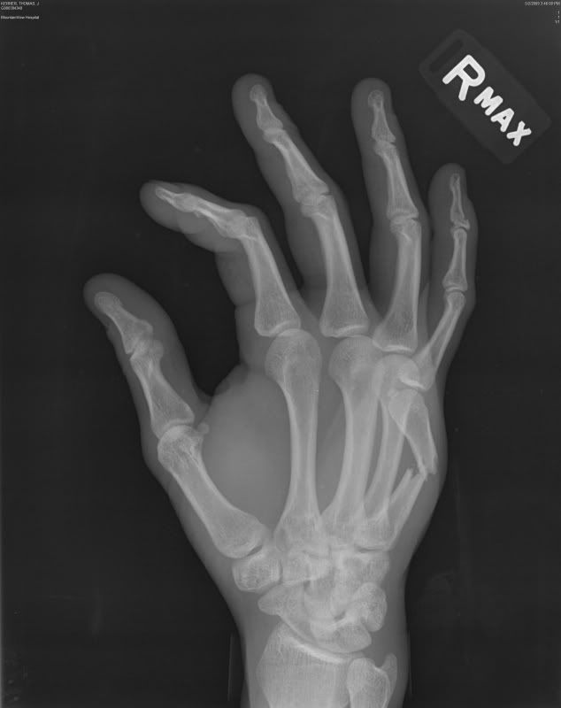 Ever hurt your hand punching something?