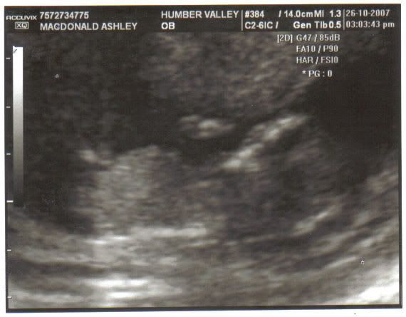 12 5 week ultrasound. this was at around 12-13 weeks