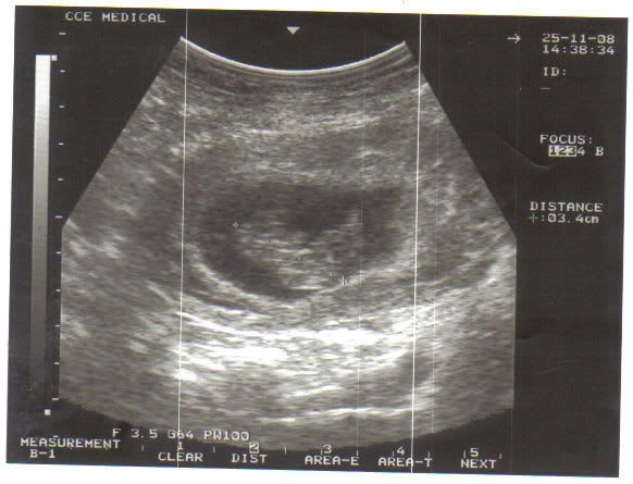 12 5 week ultrasound. this was at around 12-13 weeks